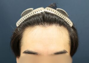 【1回目】施術前