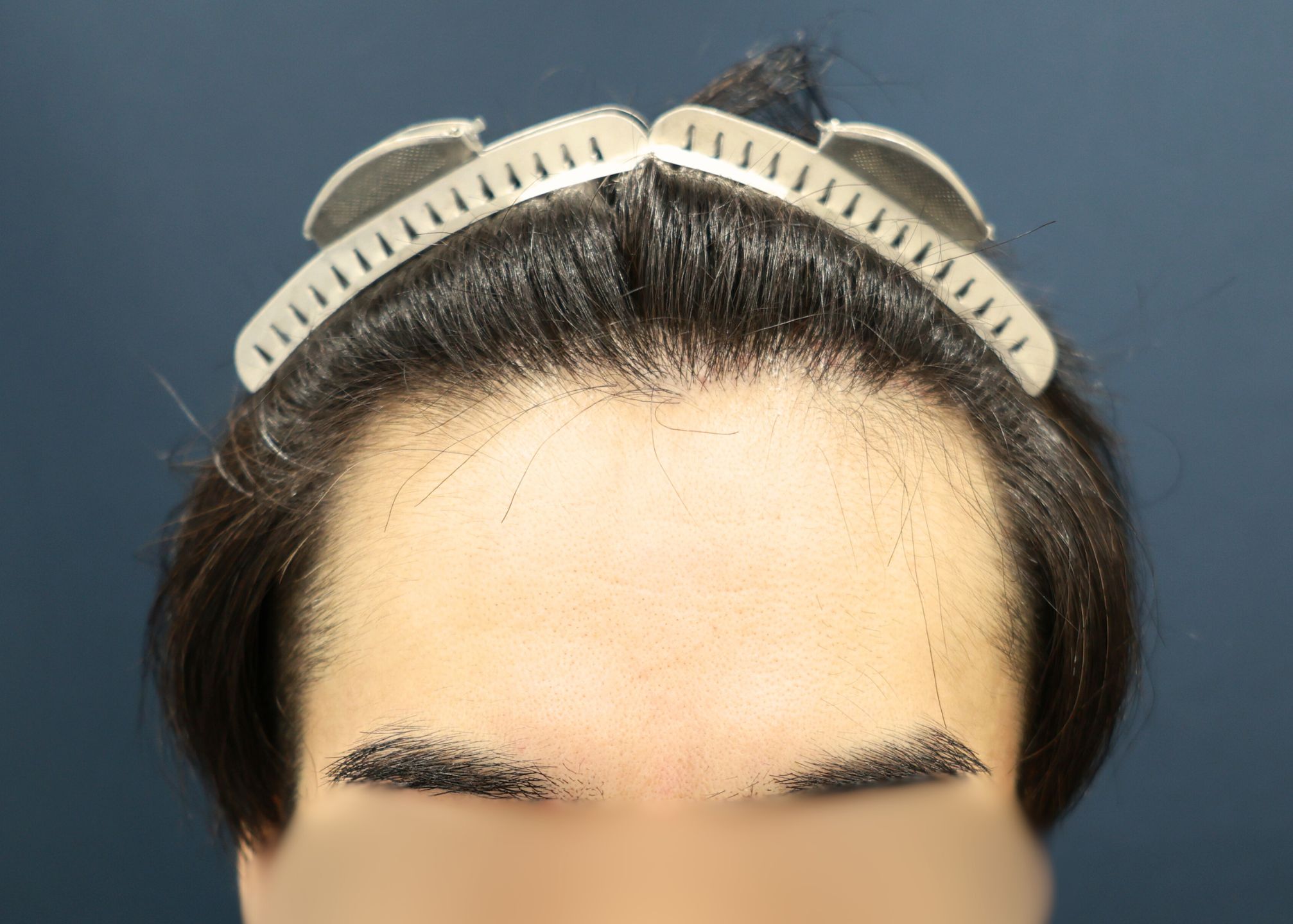 【1回目】施術前