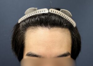 【2回目】術後6ヶ月