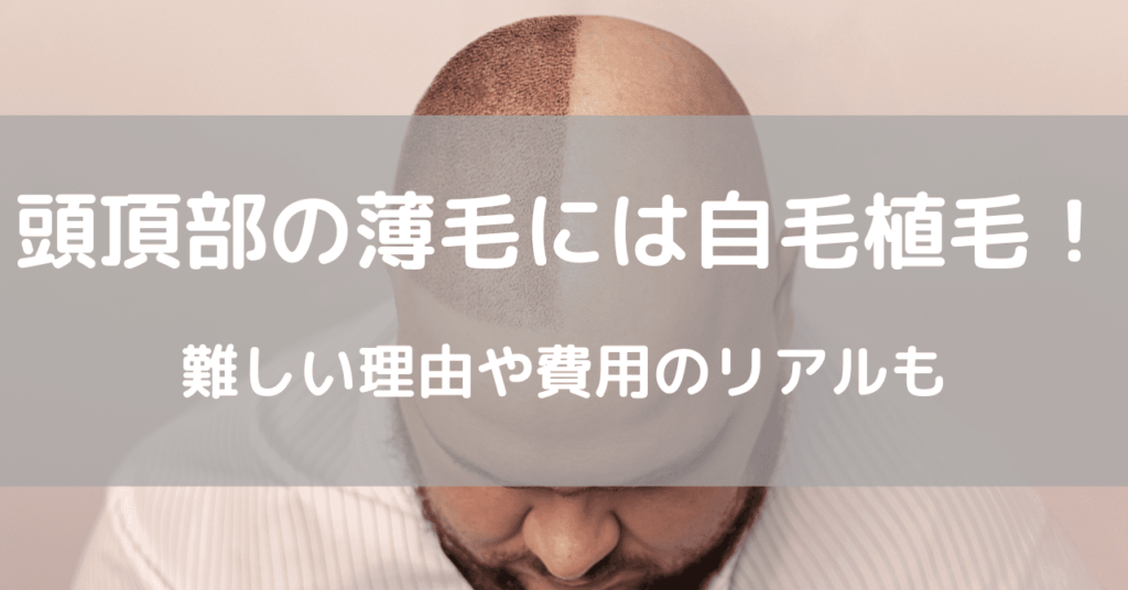 頭頂部の薄毛も自毛植毛でOK！難しい理由とかかる費用のリアルも