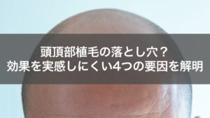 頭頂部の植毛はやめたほうがいい？効果が出にくい・遅い4つの理由