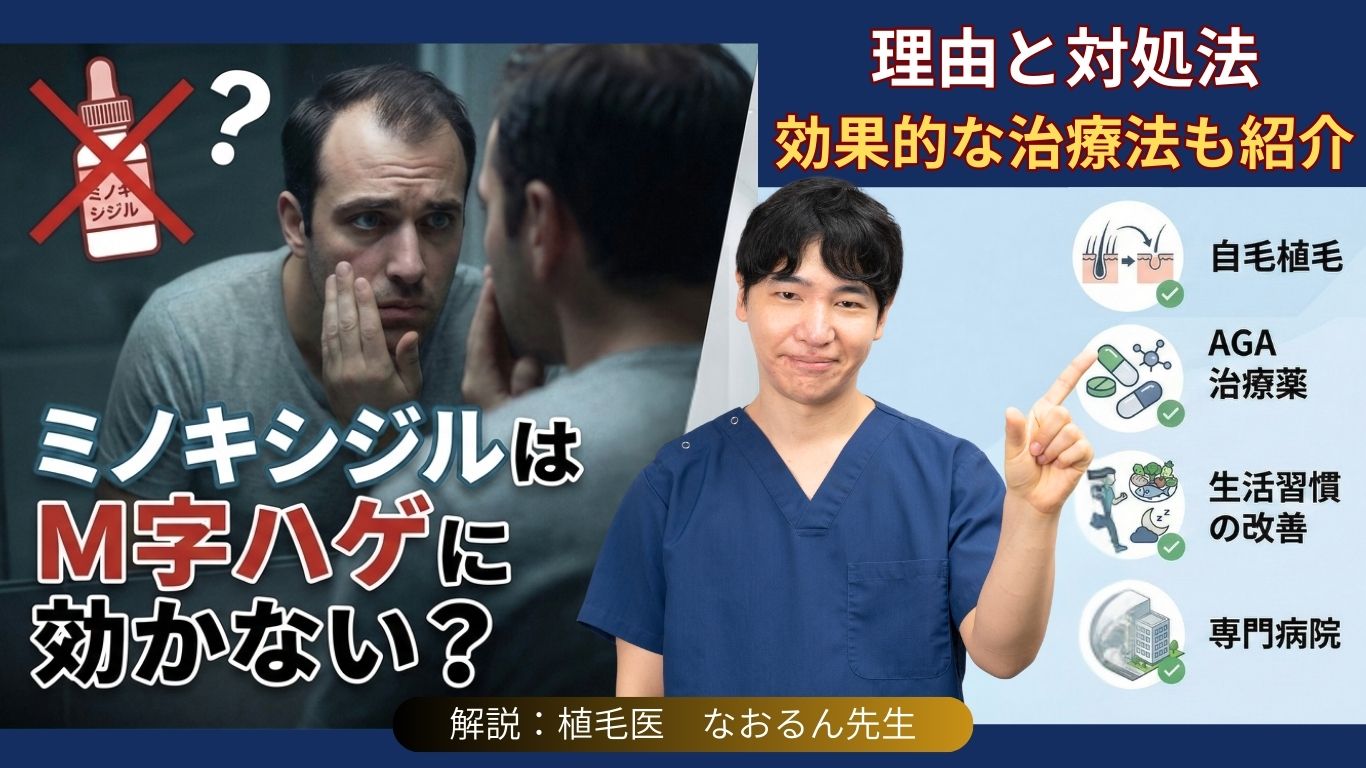 ミノキシジルはM字ハゲに効かない？理由と対処法｜効果的な治療法も紹介