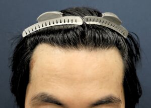 【2回目】術後6ヶ月