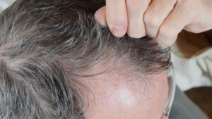 【医師監修】牽引性脱毛症とは？原因・症状・診断・治療・予防