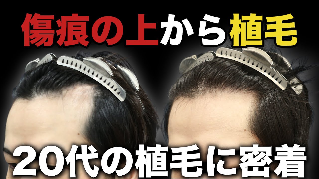 【自毛植毛】20代男性の植毛手術に密着！薬のみでは改善できなかったM字ハゲ…。術後9ヶ月経過