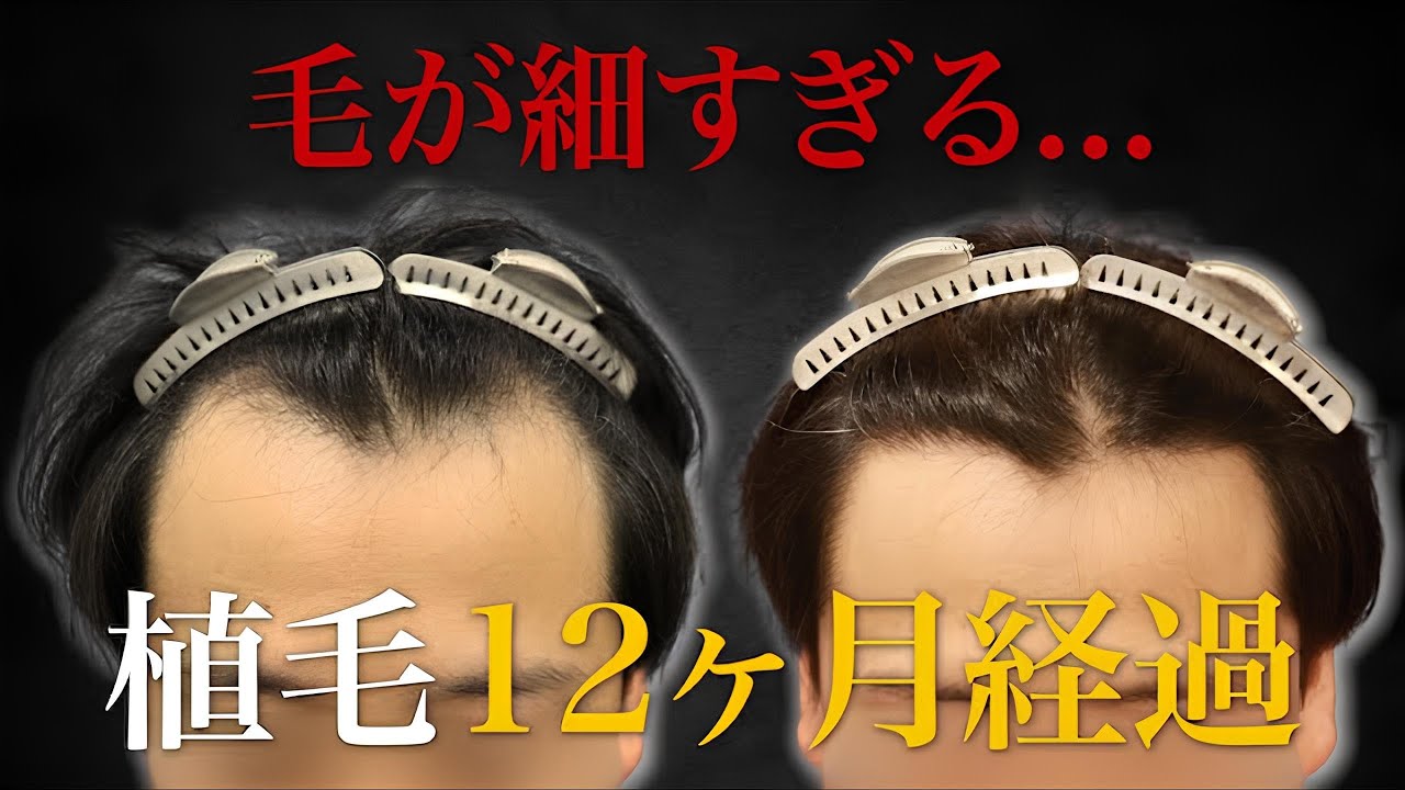 【40代薄毛】毛が細いと失敗する！？生え際のM字部分に植毛して12ヶ月後