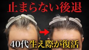 【40代のリアル】自毛植毛6ヶ月後、生え際がここまで変わる！年相応なデザインとは？