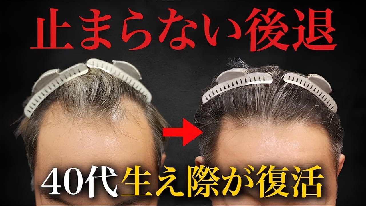 【40代のリアル】自毛植毛6ヶ月後、生え際がここまで変わる！年相応なデザインとは？