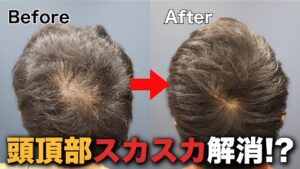 【30代薄毛】深刻な頭頂部の透け感。植毛6ヶ月後の劇的変化！