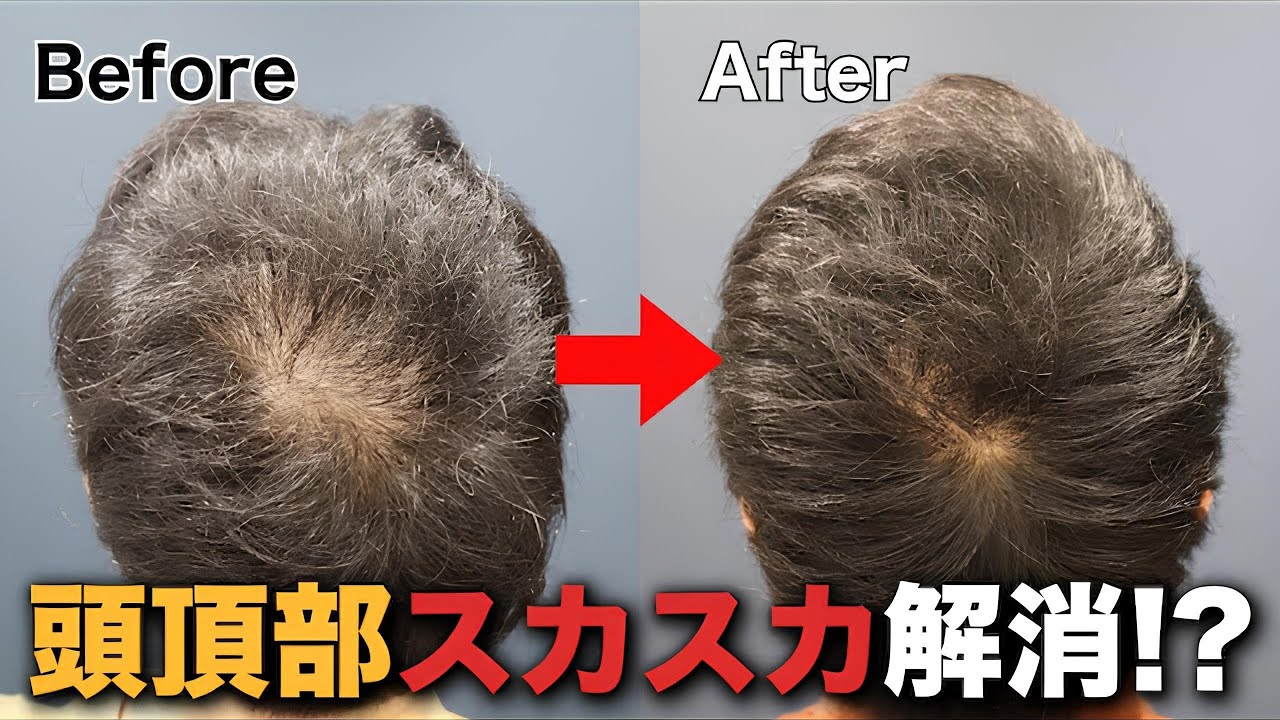 【30代薄毛】深刻な頭頂部の透け感。植毛6ヶ月後の劇的変化！