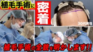 【密着映像】1500グラフト植毛の手術風景を公開！【自毛植毛:AGA治療】