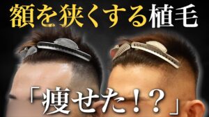 【自毛植毛】広くなったおでこを狭くしたい…30代男性の施術12ヶ月後