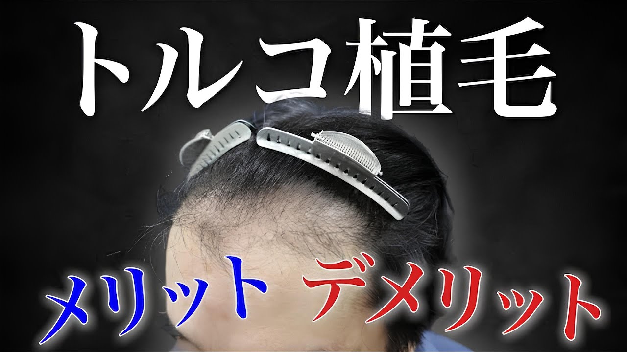 【危険】安すぎるトルコ植毛。術直後がエグすぎた…