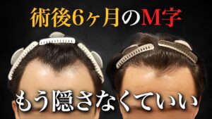 【40代植毛】術後6ヶ月の結果に驚愕！成功の鍵は〇〇植毛