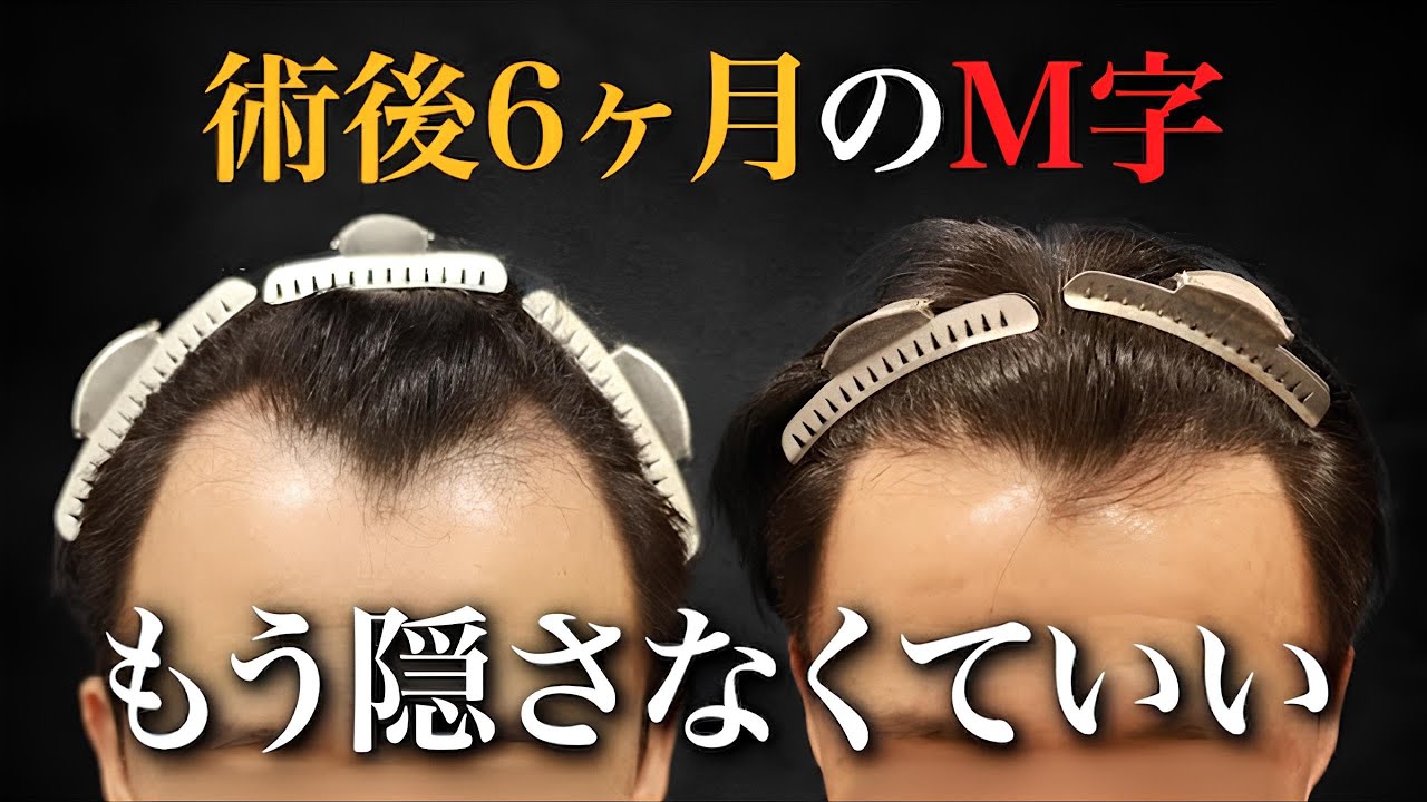 【40代植毛】術後6ヶ月の結果に驚愕！成功の鍵は〇〇植毛