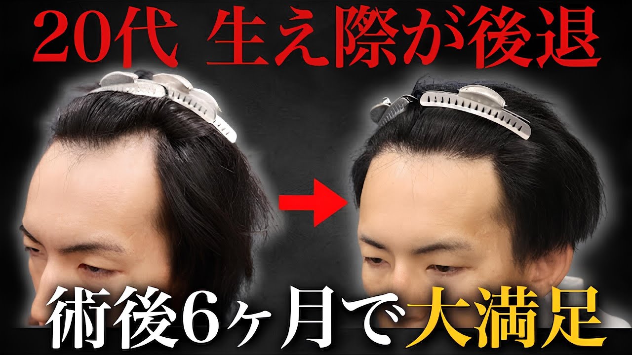 【衝撃】抜け毛がやばい…決意した20代男性の自毛植毛6ヶ月後