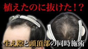 【30代薄毛】生え際と頭頂部に植毛して1年経過。ショックロスを最低限に抑えるためには…。