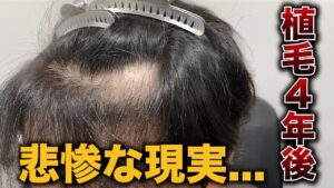 【絶望】植えたはずがスカスカに！？2回目の植毛6ヶ月後の結果は…