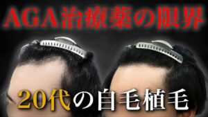 【20代植毛】AGA治療薬を内服するも、どんどん後退する生え際…