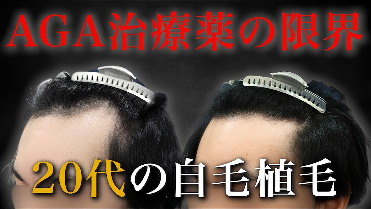【20代植毛】AGA治療薬を内服するも、どんどん後退する生え際…