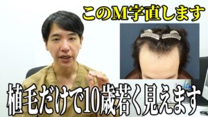 【必見】植毛でM字を無くして若返らせた方法を解説します！