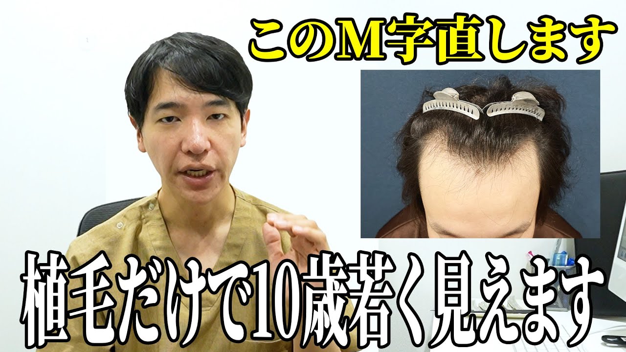 【必見】植毛でM字を無くして若返らせた方法を解説します！