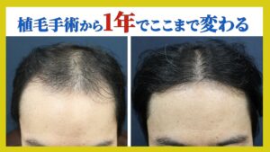 【驚愕】たった1年でここまで変化した！手術症例を紹介します！！