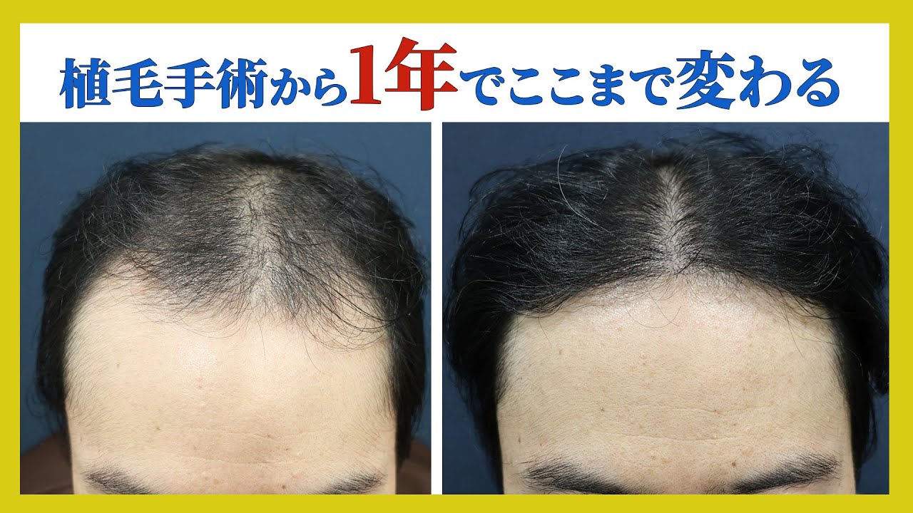 【驚愕】たった1年でここまで変化した！手術症例を紹介します！！