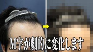 【後悔しない】飲み薬は効果無し！植毛でしか治せない生え際の症例を解説します