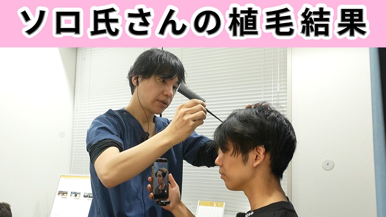 【結果発表】インフルエンサーのソロ氏さんの植毛の結果を発表します！