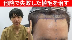 【失敗しない】他院での植毛手術で失敗したので手術をやり直す！