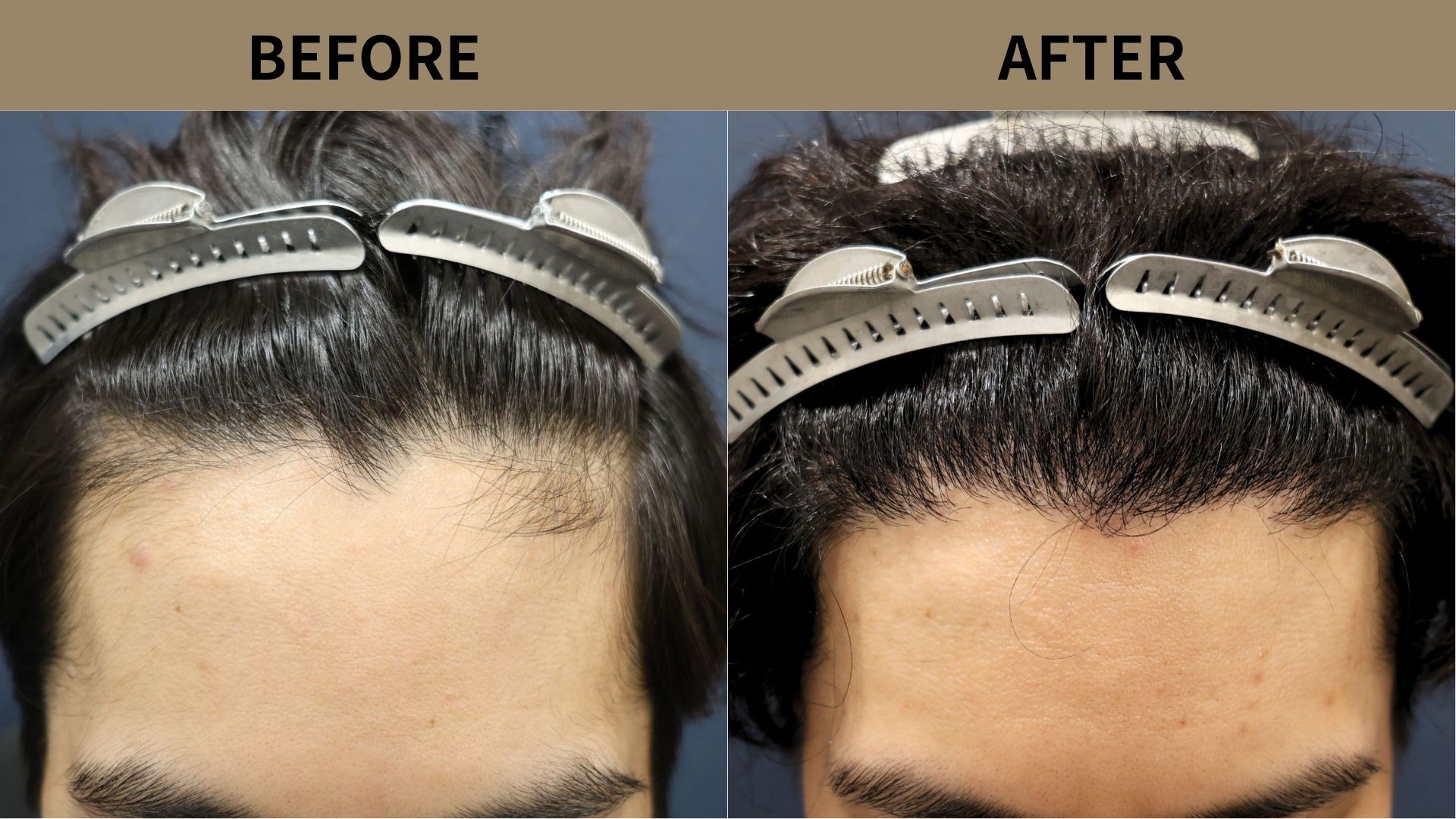 【植毛 症例更新】20代男性｜生え際の薄毛・当院2回目1000グラフト