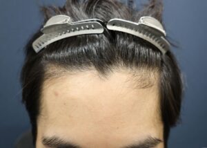 【1回目】施術前