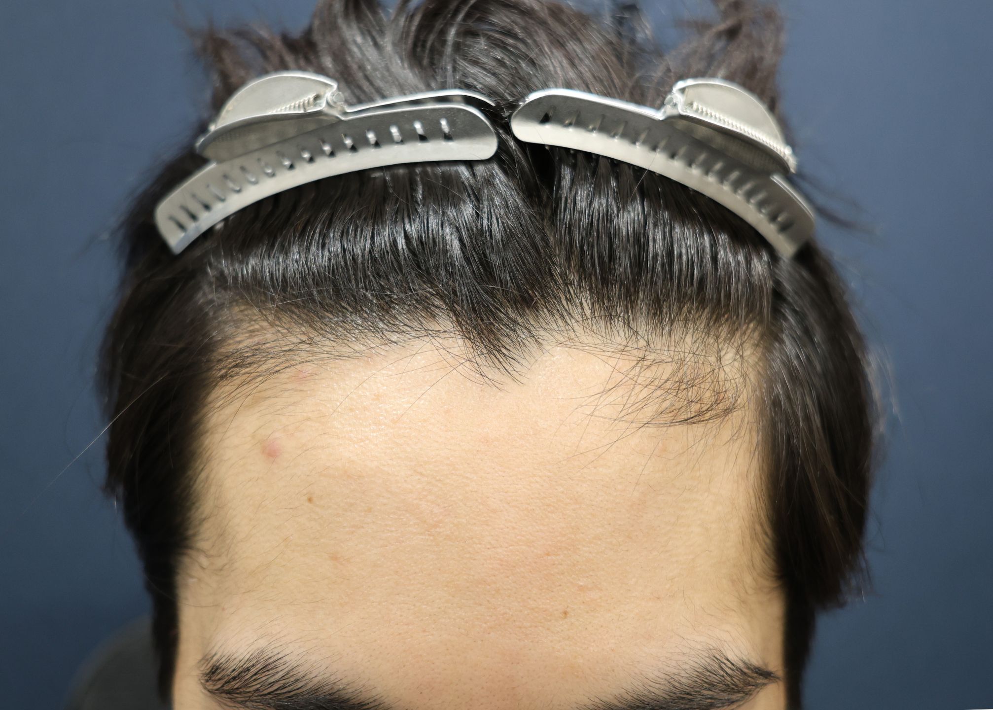 【1回目】施術前