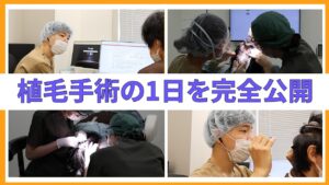 【大公開】見逃し厳禁！植毛手術の1日の流れをお見せします！