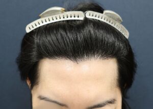 【2回目】術後1年