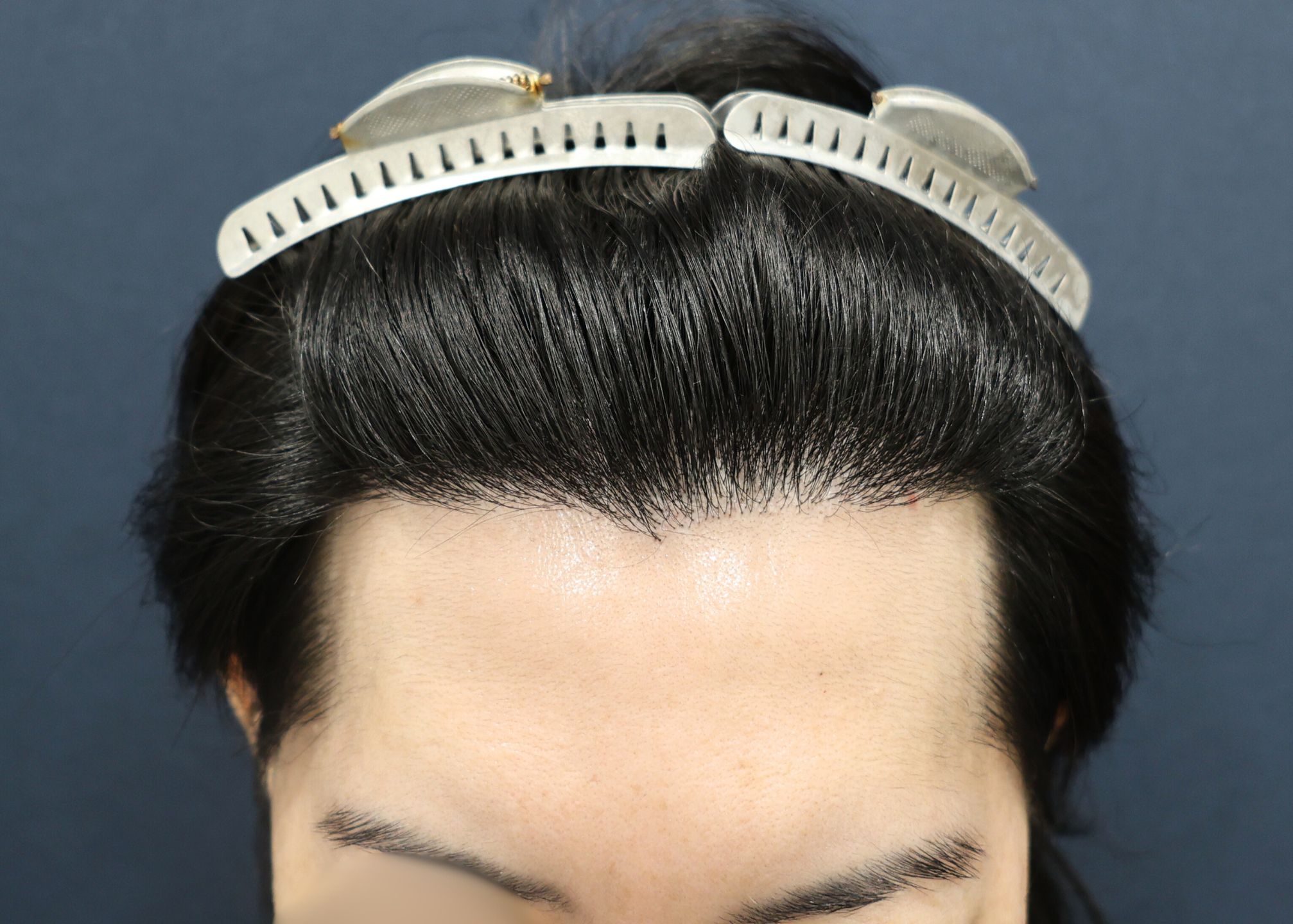 【2回目】術後1年