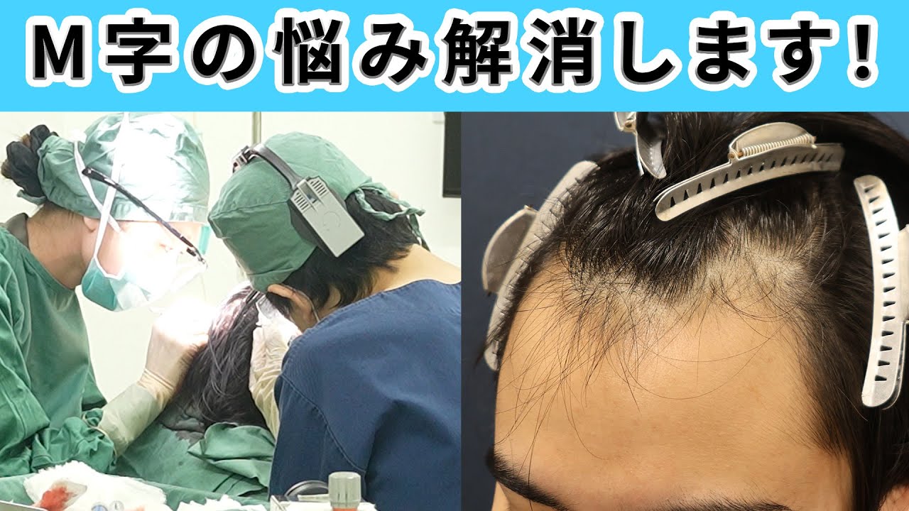 【悩み解決】気になるM字を植毛で治す手術をお見せします！！