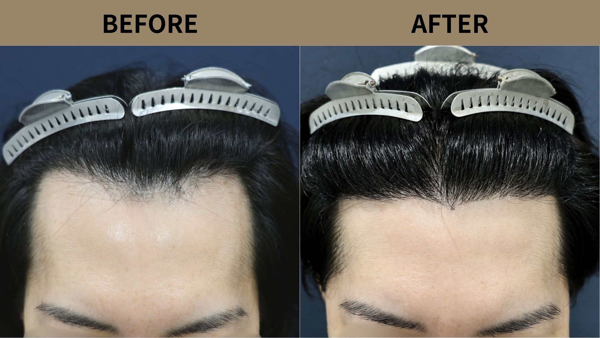 【植毛 症例更新】40代男性｜生え際の薄毛・他院修正・当院2回目1200グラフト