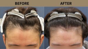 【植毛 症例更新】30代男性｜生え際の薄毛1500グラフト