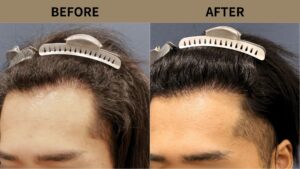 【自毛植毛 症例更新】20代男性｜他院修正・生え際の薄毛1200グラフト
