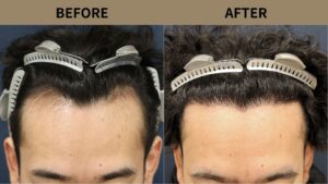 【植毛 症例更新】20代男性｜生え際・M字の薄毛1800グラフト