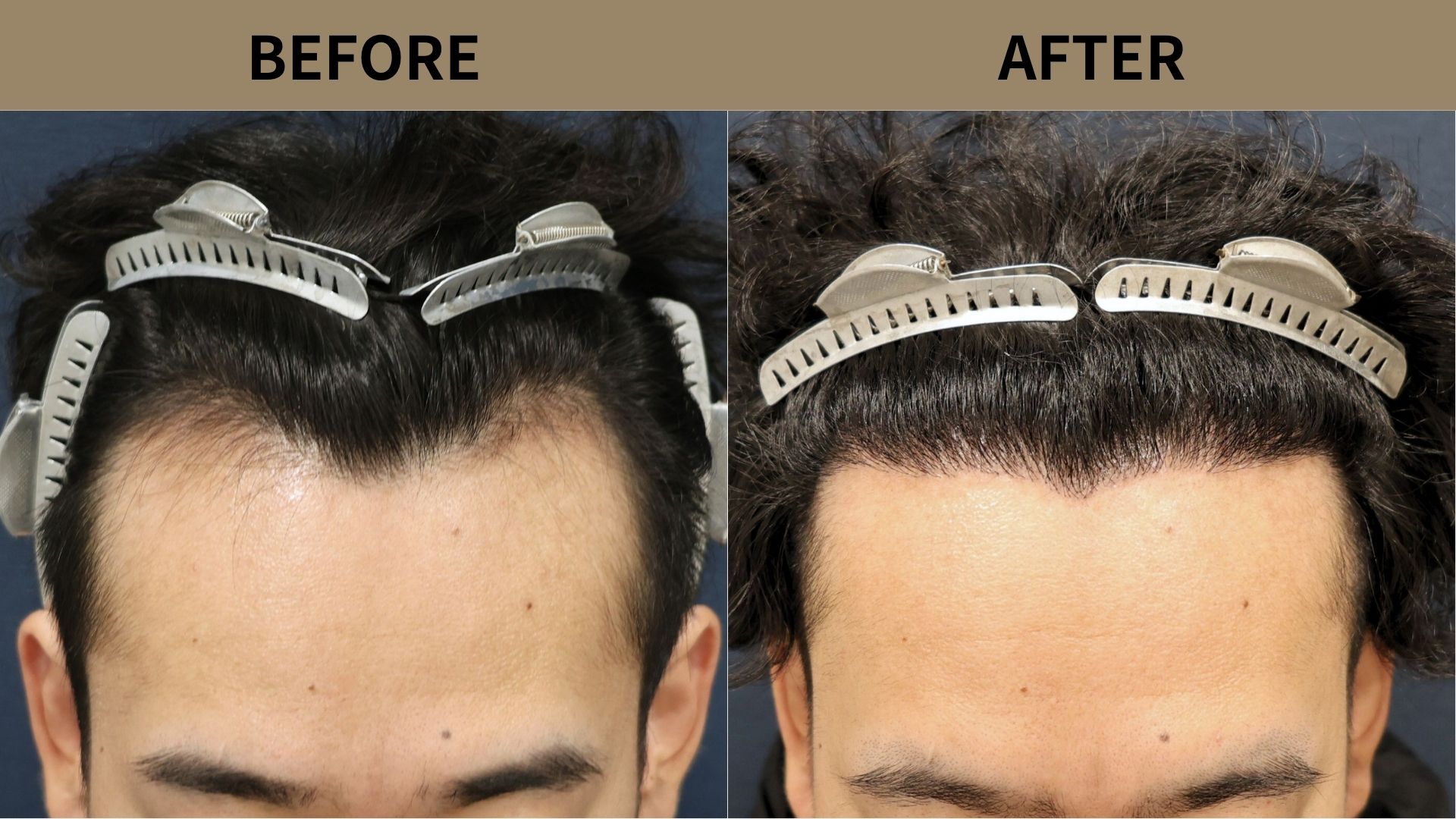 【植毛 症例更新】20代男性｜生え際・M字の薄毛1800グラフト