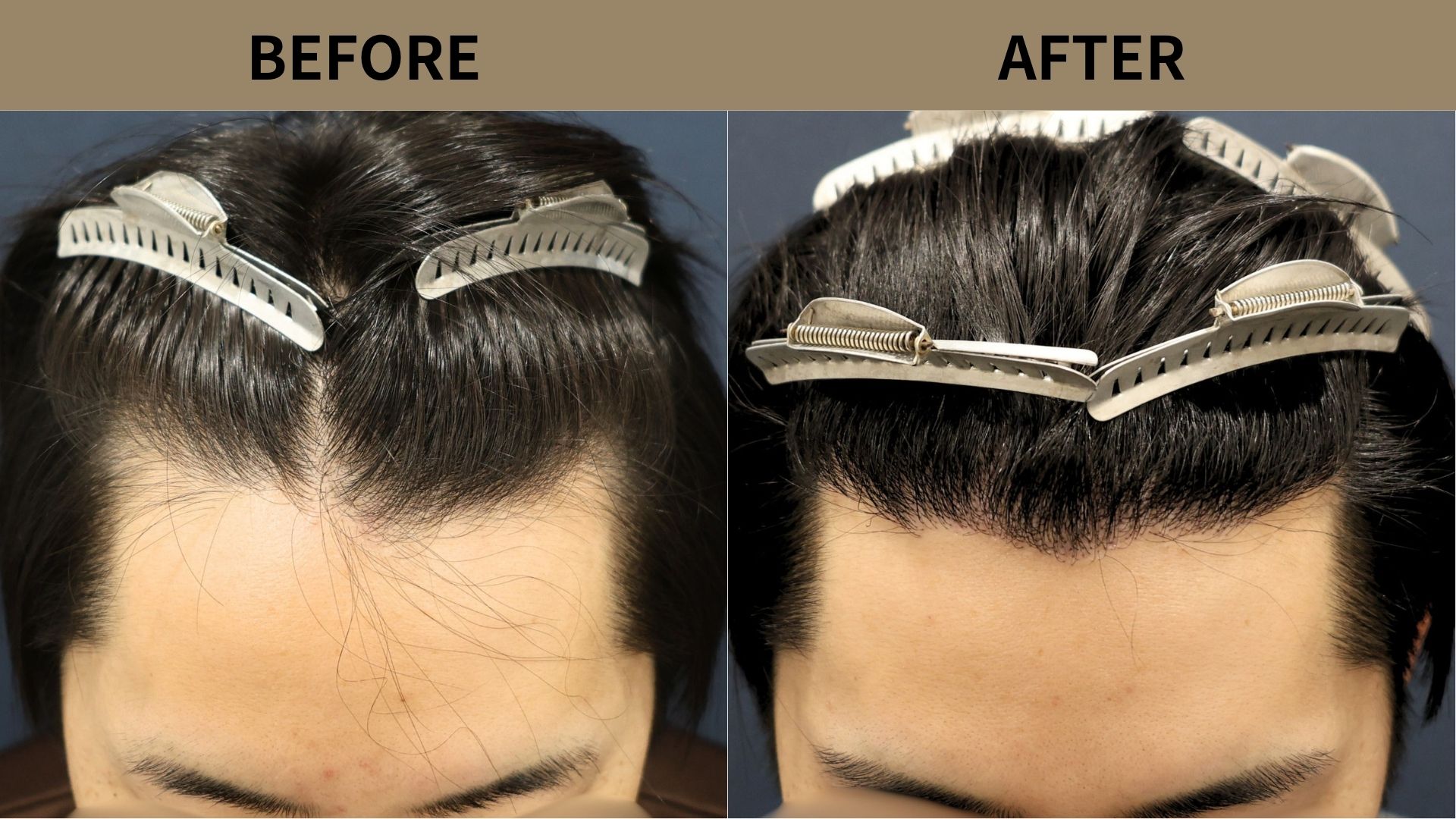 【自毛植毛 症例更新】20代男性｜生え際の薄毛1500グラフト