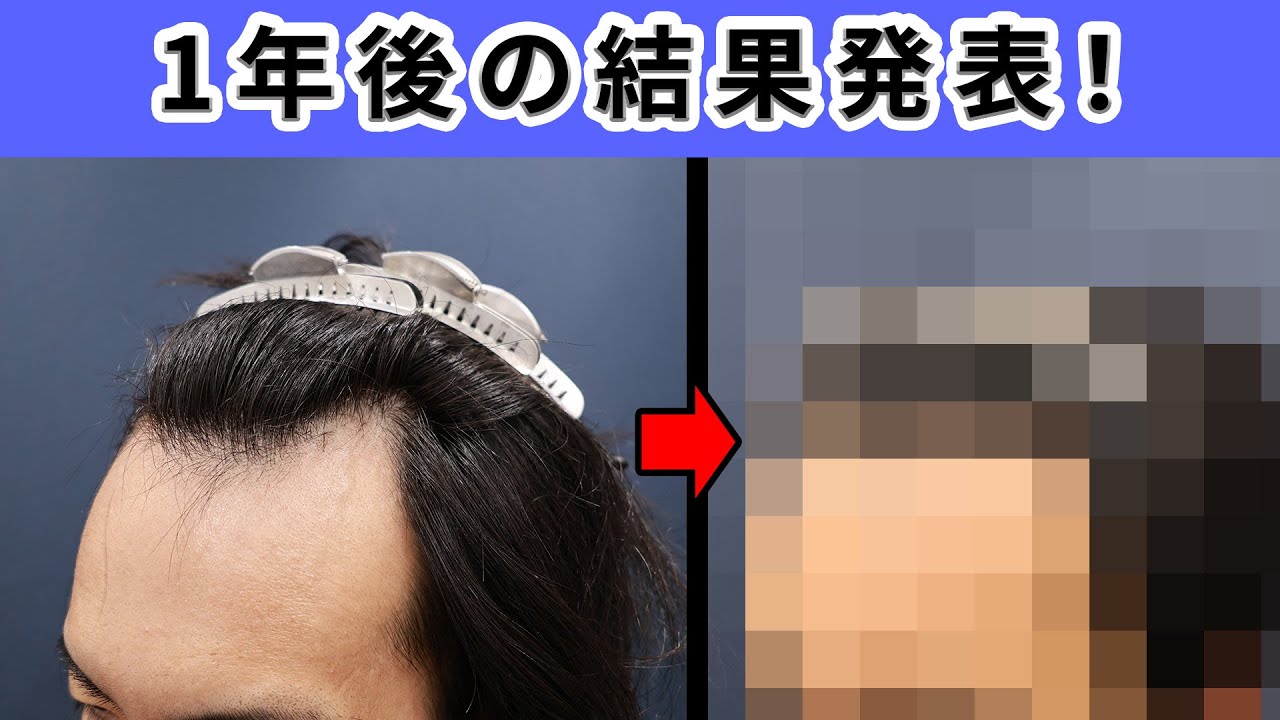 【結果】植毛をして1年が経過！驚きの結果をお見せします
