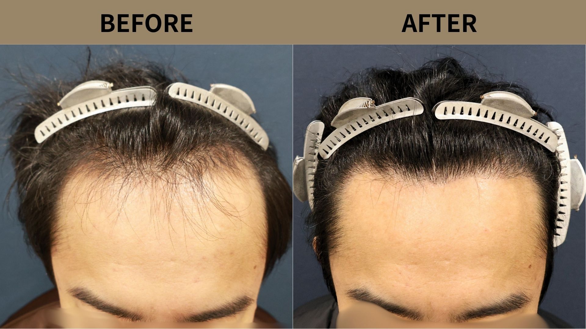 【自毛植毛 症例更新】30代男性｜生え際・前頭部の薄毛1500グラフト