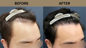 【自毛植毛 症例更新】30代男性｜生え際の薄毛1600グラフト