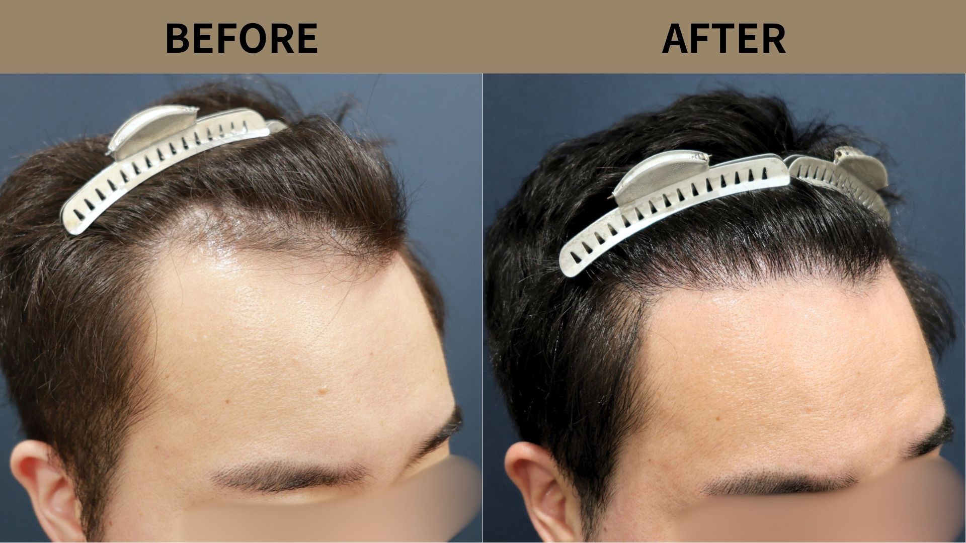 【自毛植毛 症例更新】30代男性｜生え際の薄毛1600グラフト