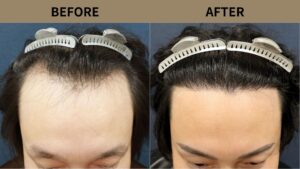 【自毛植毛 症例更新】30代男性｜生え際・前頭部の薄毛2200グラフト
