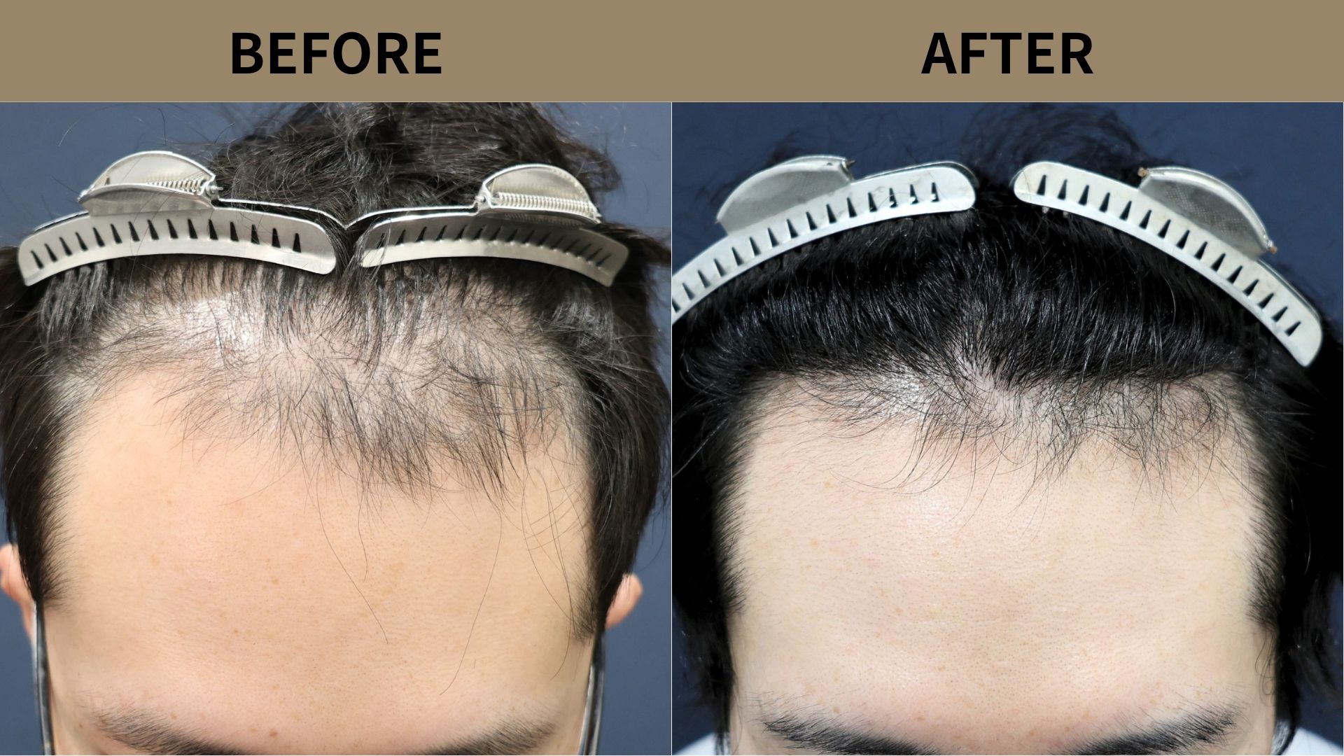 【自毛植毛 症例更新】30代男性｜生え際の薄毛・当院2回目800グラフト